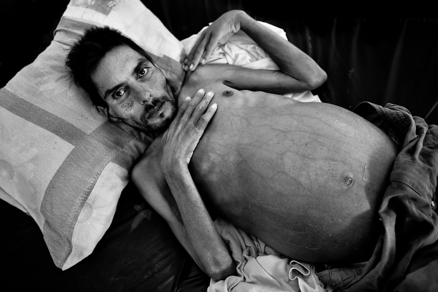 A Honduran immigrant suffering cirrhosis of the liver lies in a refugee shelter in Tapachula, Mexico.