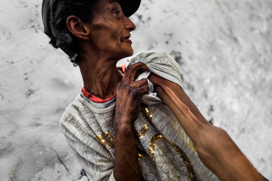 A Colombian woman shows off a large scar on her arm, a result of a knife attack by her male partner, in Colombia.