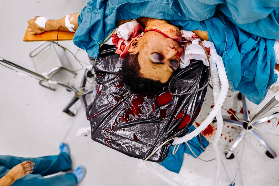 A young gang member, with a gunshot wound to the head, lies on the strecher during the life-saving surgery in the operating room of a public hospital in San Salvador.