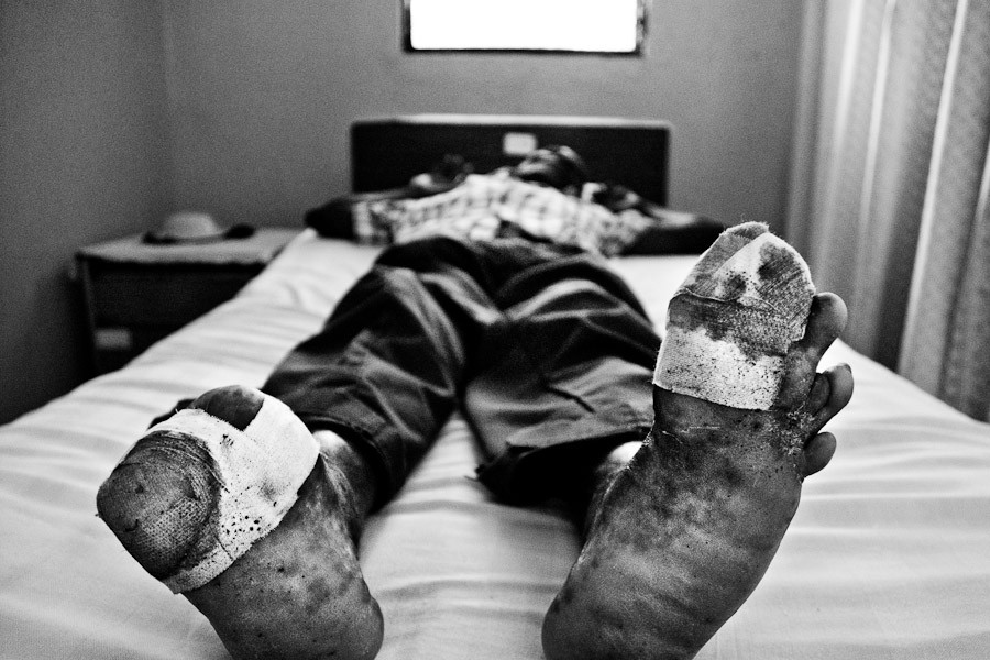 A leprous man waiting for an ambulatory treatment in the Hopital Cardinal Leger (Léogane, Haiti).