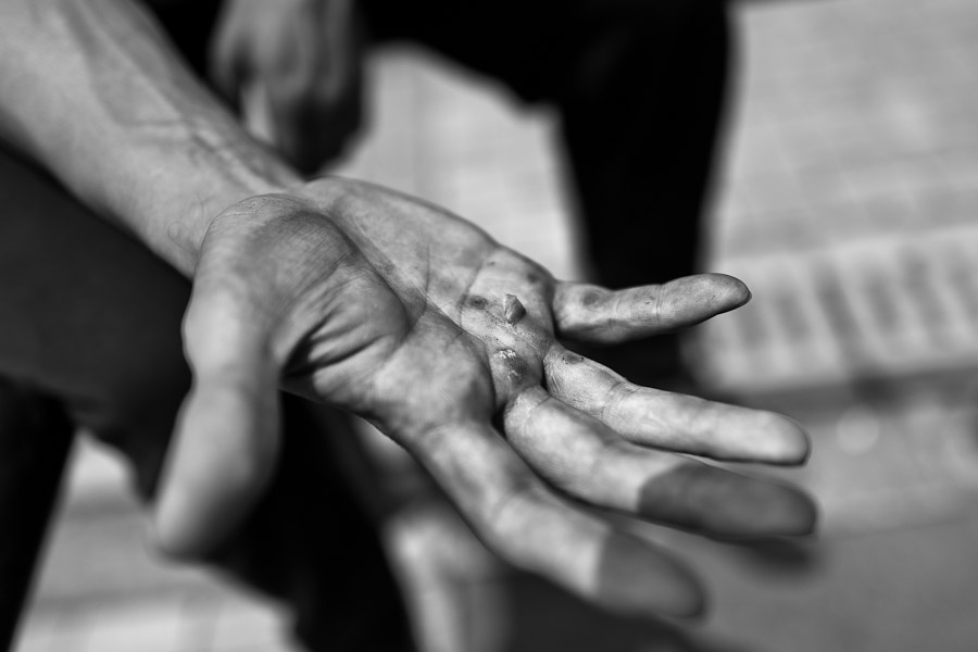 Logan Franco, a parkour runner from Tamashikaze team, shows blisters caused by wall jumping during a free running training session in Bogotá, Colombia.